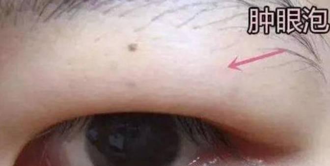 手術(shù)消除腫眼泡做完要多久時(shí)間？