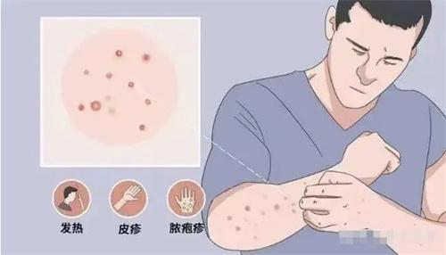 天津、長沙等地發(fā)現猴痘病例，猴痘病毒感染引發(fā)關注