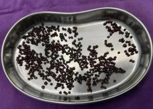 誤診為胃?。?6歲王阿姨腹痛腹脹半年，最終發(fā)現(xiàn)膽囊結(jié)石